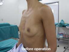 plastic-surgery-breast-augmentation 